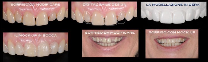 Faccette Dentali - Studio Odontoiatrico Tessore