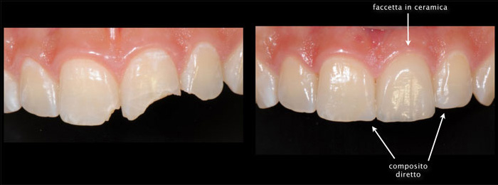 fratture-dentali-4.jpg